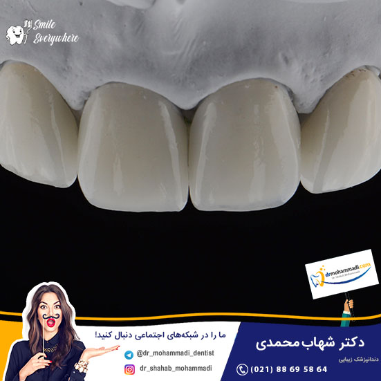 درباره کاربرد روش های مدرن اصلاح طرح لبخند با کامپوزیت دندان بیشتر بدانید - کلینیک دندانپزشکی دکتر شهاب محمدی
